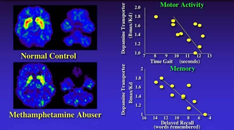 Meth Abuse Brain Scans